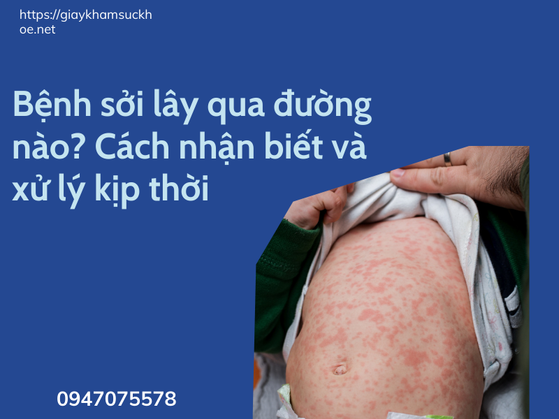 Bệnh sởi: Những thông tin quan trọng mà bạn cần phải biết!