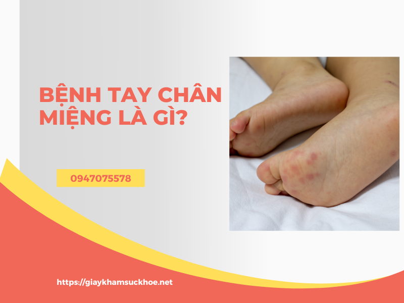 Cách phòng và điều trị bệnh tay chân miệng tại nhà hiệu quả